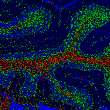 Raman image of brain glioma